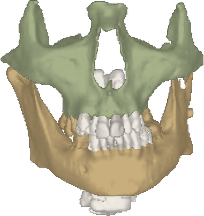 Segmentación de CBCT